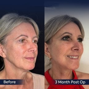 Before and after neck lift results at Dr. Safa Manav Clinic, visible jawline and neck improvement