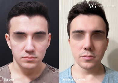 Resultado de rinoplastia antes y después en VG Plastic Surgery, remodelación nasal tras 3 meses