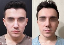Resultado de rinoplastia antes y después en VG Plastic Surgery, remodelación nasal tras 3 meses