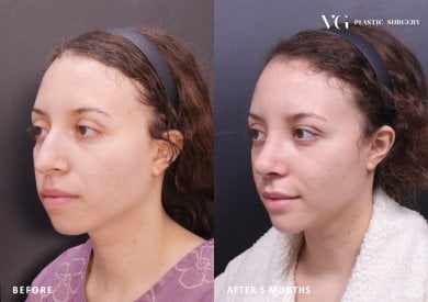 Before and after rhinoplasty result at VG Plastic Surgery, nose reshaping after 5 months