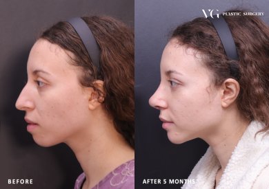 Before and after rhinoplasty results at VG Plastic Surgery, nose reshaping after 5 months