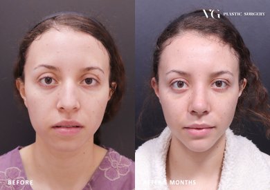 Before and after rhinoplasty results at VG Plastic Surgery, nose reshaping after 5 months
