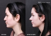 نتائج تجميل الأنف قبل وبعد في VG Plastic Surgery، تغيير واضح للأنف بعد 10 أيام