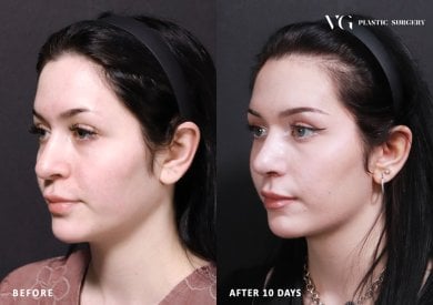 نتائج تجميل الأنف قبل وبعد في VG Plastic Surgery، شكل أنف محسّن بعد 10 أيام