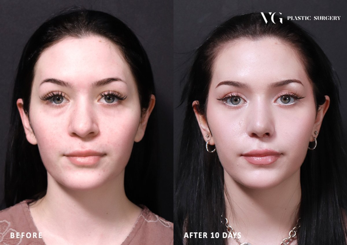 Before and after rhinoplasty results at VG Plastic Surgery, nose reshaping after 10 days