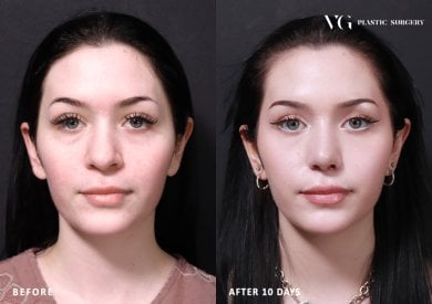 نتائج عملية تجميل الأنف قبل وبعد في VG Plastic Surgery، تغيير شكل الأنف بعد 10 أيام