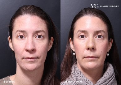 Resultados de rinoplastia antes y después en VG Plastic Surgery, cambio nasal tras 7 días