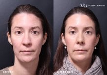 Resultados de rinoplastia antes y después en VG Plastic Surgery, cambio nasal tras 7 días