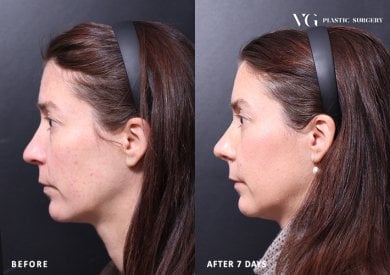نتائج تجميل الأنف قبل وبعد في VG Plastic Surgery، تغيير واضح للأنف بعد 7 أيام