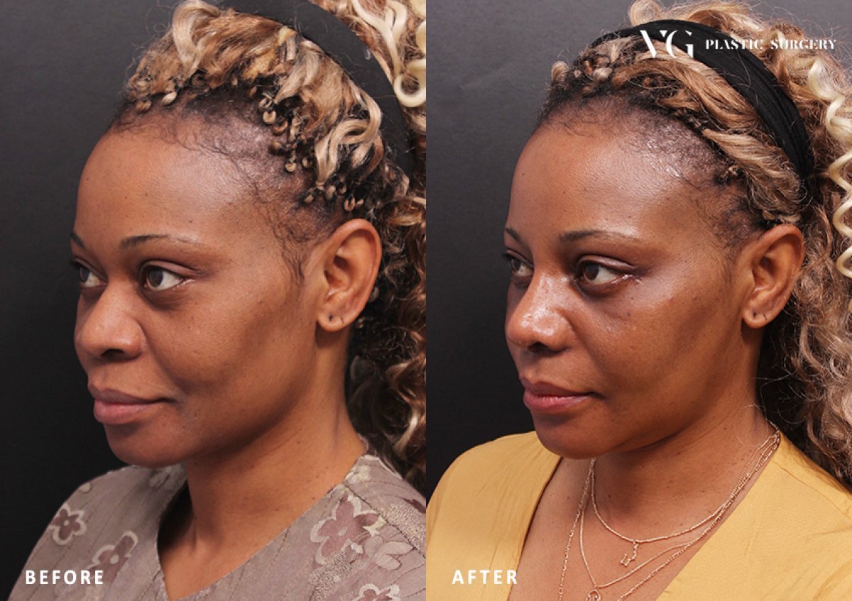 Vorher-nachher-Rhinoplastik-Ergebnis bei VG Plastic Surgery, natürliche Nasenkorrektur