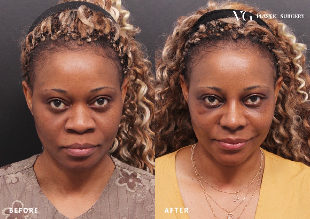 Vorher-nachher-Ergebnis der Blepharoplastik bei VG Plastic Surgery, frischerer Blick