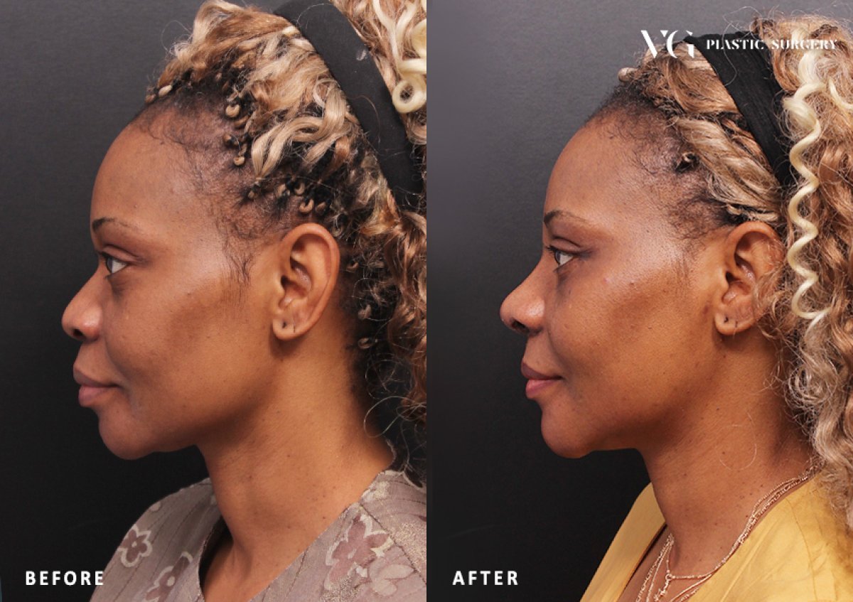 Vorher-nachher-Ergebnis der Nasenkorrektur bei VG Plastic Surgery, verbesserte Nasenkontur