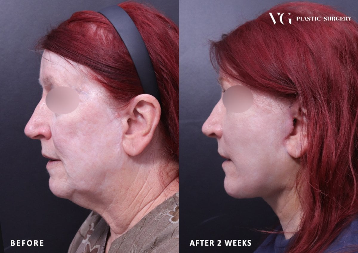 نتائج شد الوجه قبل وبعد في VG Plastic Surgery، تجديد واضح للوجه خلال أسبوعين
