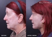Facelift Vorher-Nachher-Ergebnisse bei VG Plastic Surgery, sichtbare Verjüngung in 2 Wochen