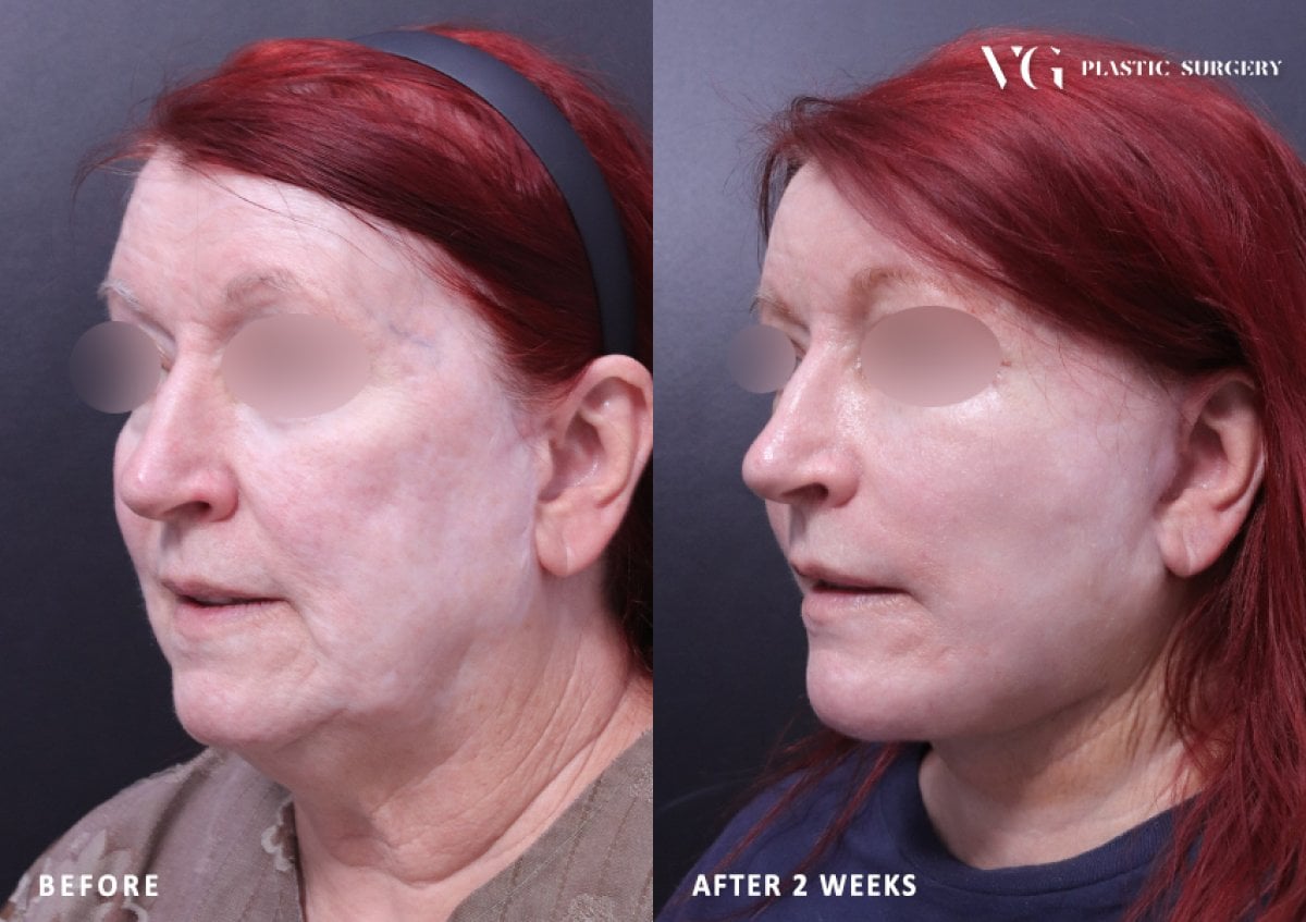 Resultados de lifting facial antes y después en VG Plastic Surgery – rejuvenecimiento tras 2 semanas