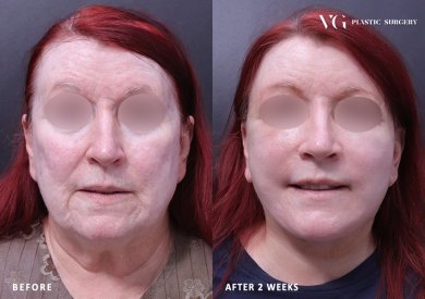 Facelift Vorher-Nachher-Ergebnisse bei VG Plastic Surgery, sichtbare Verjüngung nach 2 Wochen