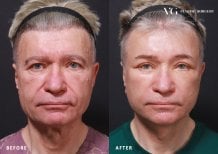 Résultats avant/après blépharoplastie chez VG Plastic Surgery, correction des paupières homme