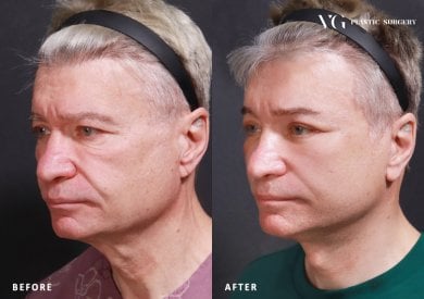 Before and after blepharoplasty results at VG Plastic Surgery, eyelid correction for men