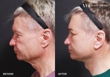 Результаты подтяжки лица до и после в VG Plastic Surgery, омоложение лица у мужчины