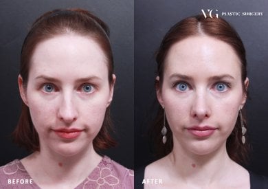 Resultados de rinoplastia antes y después en VG Plastic Surgery, remodelación nasal natural