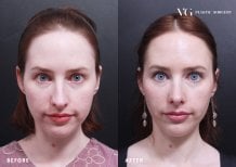 Resultados de rinoplastia antes y después en VG Plastic Surgery, remodelación nasal natural