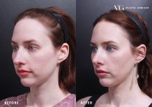 نتائج عملية تجميل الأنف قبل وبعد في VG Plastic Surgery، إعادة تشكيل الأنف بمظهر طبيعي