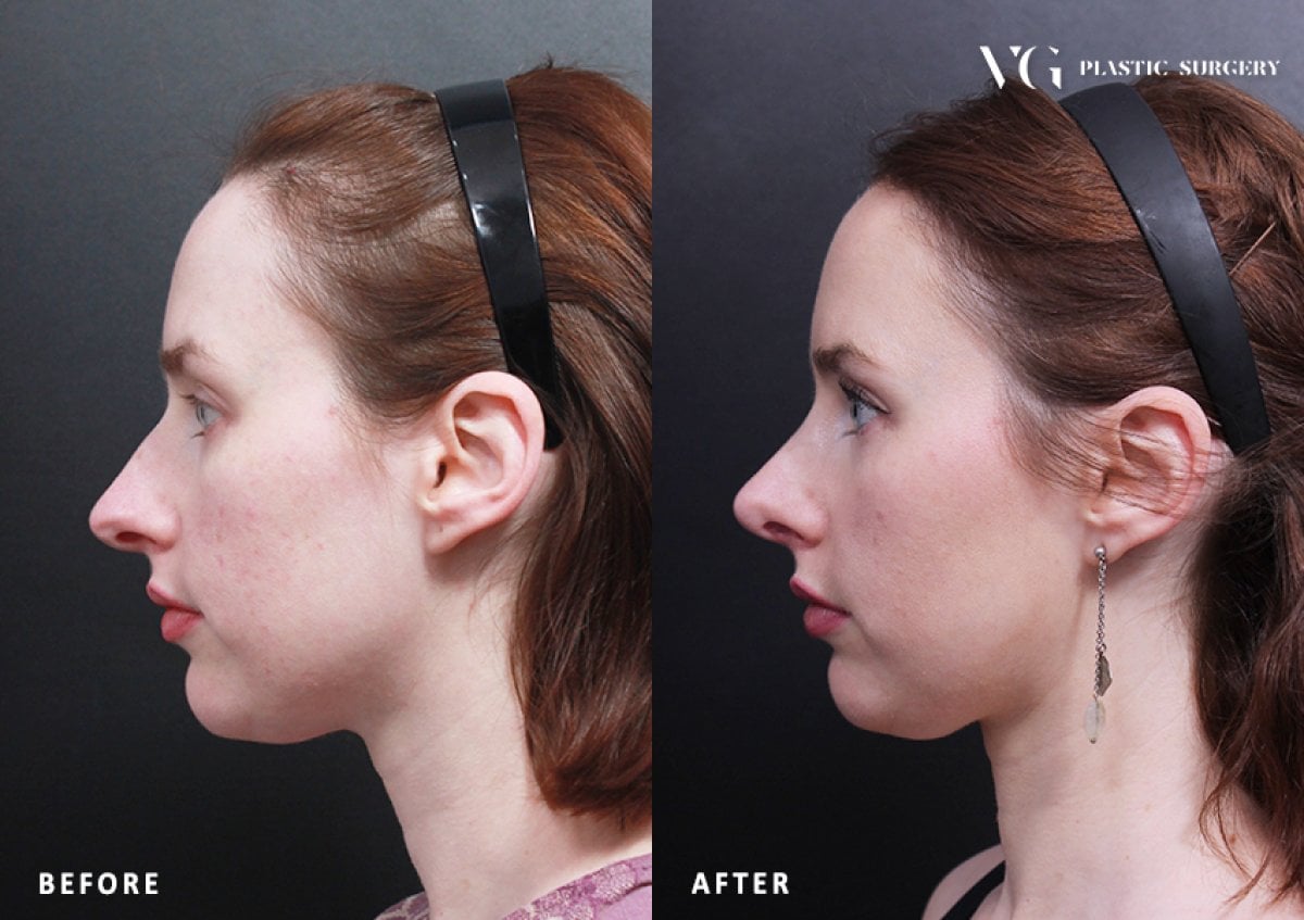 Resultados de rinoplastia antes y después en VG Plastic Surgery, perfil nasal mejorado