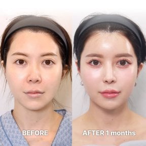 Before and after tip rhinoplasty results at Returning Plastic Surgery, refined nose shape
