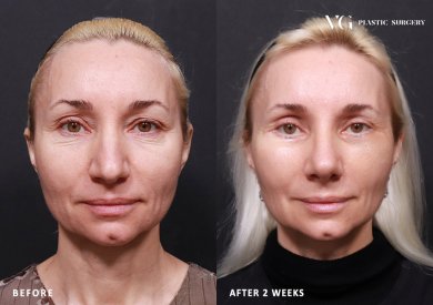 Blepharoplasty before and after results at VG Plastic Surgery – eyelid correction improvement