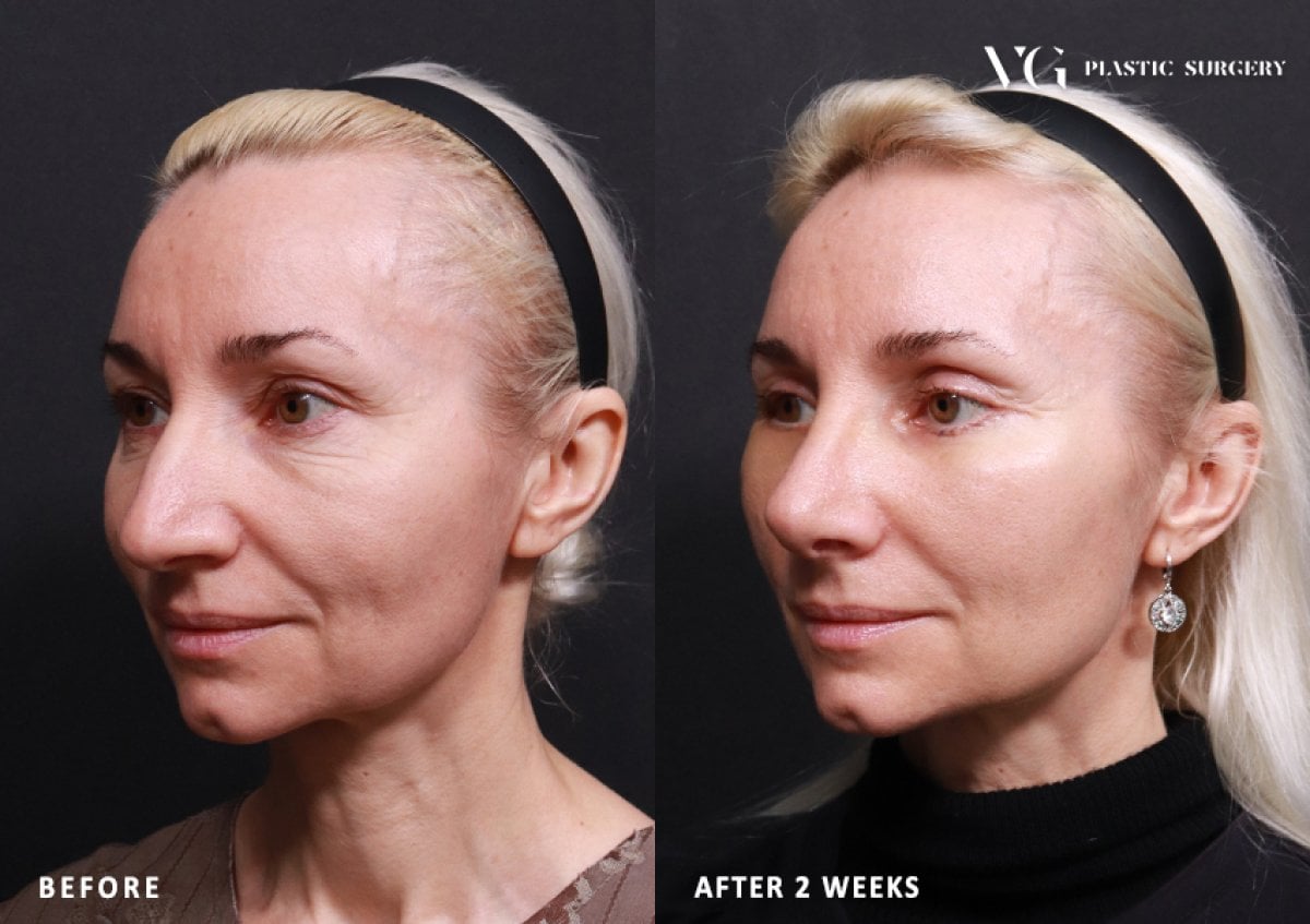 نتائج رأب الجفن قبل وبعد في VG Plastic Surgery، تصحيح الجفن بعد أسبوعين