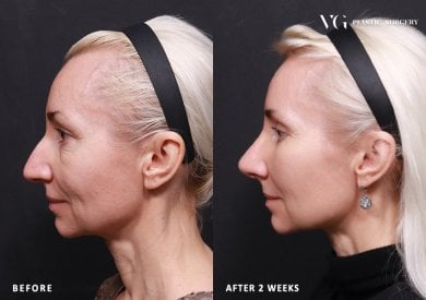 Facelift before and after results at VG Plastic Surgery – visible facial rejuvenation in 2 weeks