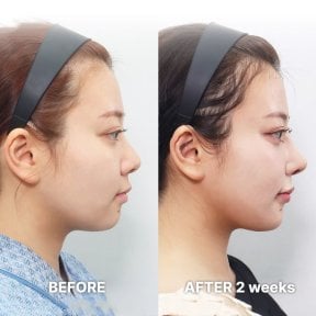 Before and after tip rhinoplasty results at Returning Plastic Surgery, nose reshaping visible