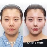 Tip rhinoplasty before and after results at Returning Plastic Surgery, refined nose shape