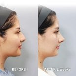 Before and after tip rhinoplasty results at Returning Plastic Surgery, nose reshaping visible