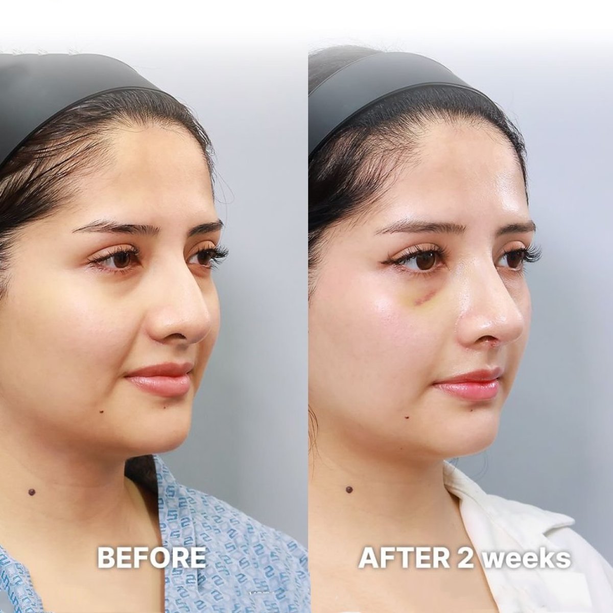 Resultados antes y después de rinoplastia de punta en Returning Plastic Surgery, 2 semanas
