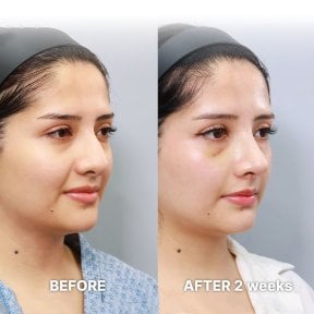 Before and after tip rhinoplasty results at Returning Plastic Surgery, 2 weeks post-op