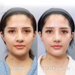 Before and after tip rhinoplasty results at Returning Plastic Surgery, 2 weeks post-op
