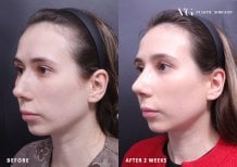 نتائج عملية تجميل الأنف قبل وبعد في VG Plastic Surgery، شكل أنف محسّن بعد أسبوعين