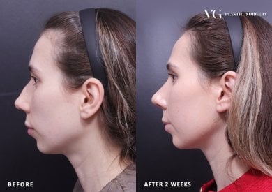 Before and after rhinoplasty results at VG Plastic Surgery, improved nose shape after 2 weeks