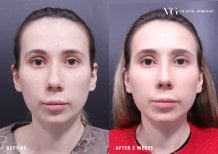 نتائج تجميل الأنف قبل وبعد في VG Plastic Surgery، إعادة تشكيل الأنف بعد أسبوعين