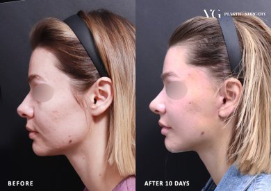 نتائج شد الوجه المصغر قبل وبعد في VG Plastic Surgery، تحسين واضح لتحديد الوجه