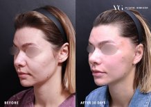 Résultats mini lifting avant/après chez VG Plastic Surgery – rajeunissement visible du visage