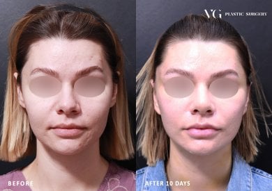 Résultats avant/après mini lifting chez VG Plastic Surgery, rajeunissement visible en 10 jours