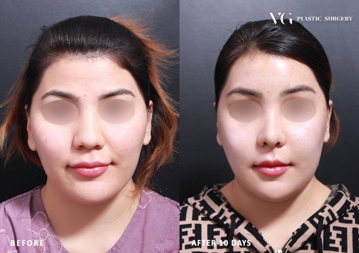 نتائج تحديد الوجه قبل وبعد في VG Plastic Surgery، تحسين واضح لشكل الوجه