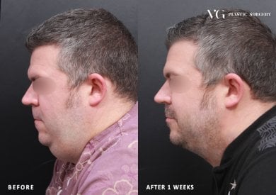 Before and after liposuction results at VG Plastic Surgery, improved jawline and neck contour