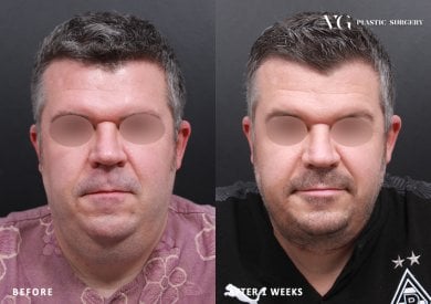 Before and after liposuction results at VG Plastic Surgery, improved facial contour in male patient