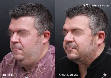 Before and after liposuction results at VG Plastic Surgery, visible chin and neck contouring