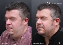 Before and after liposuction results at VG Plastic Surgery, visible chin and neck contouring