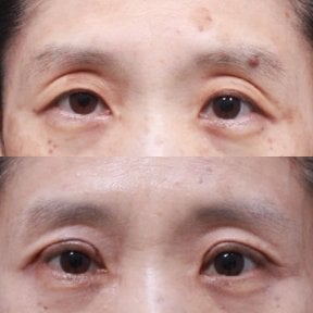 Before and after blepharoplasty results at Returning Plastic Surgery, eyelid correction improvement