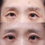 Before and after blepharoplasty results at Returning Plastic Surgery, eyelid correction improvement